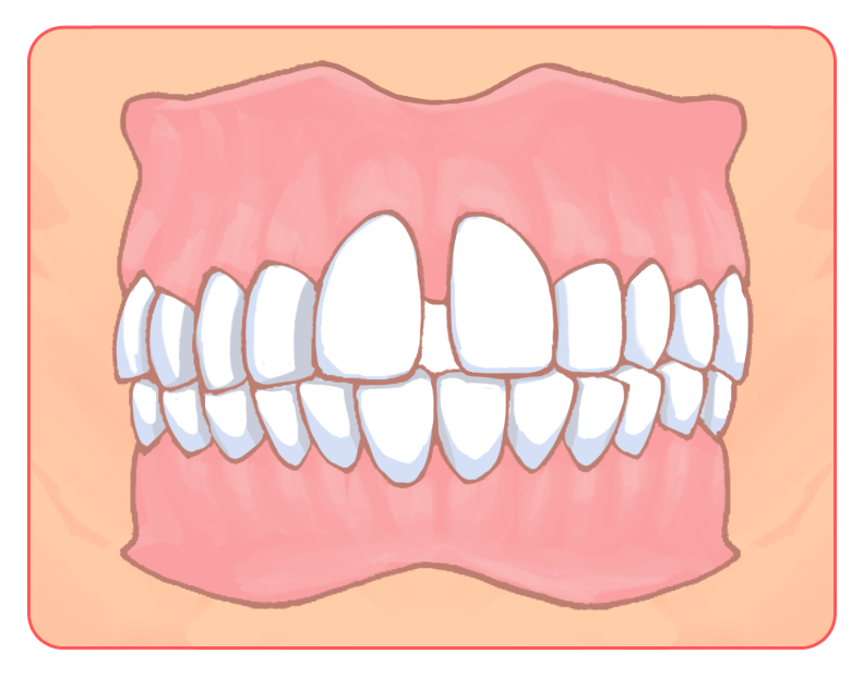 空隙歯列