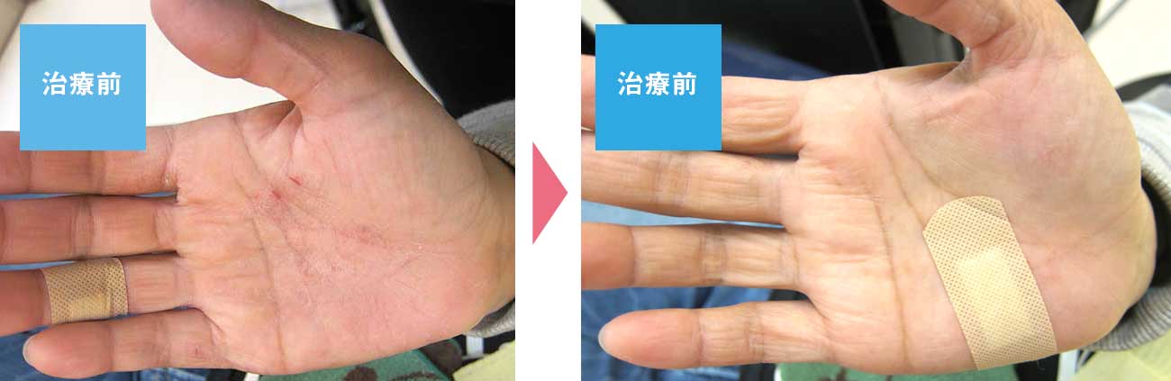 掌蹠膿疱症の症例写真