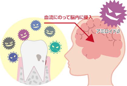 歯周病と認知症の関係 健康寿命を延ばすために 福島の歯医者 佐久間デンタルクリニック