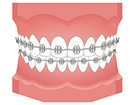 ワイヤー矯正している歯