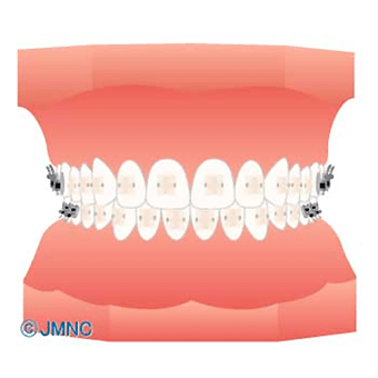 ブラケット矯正